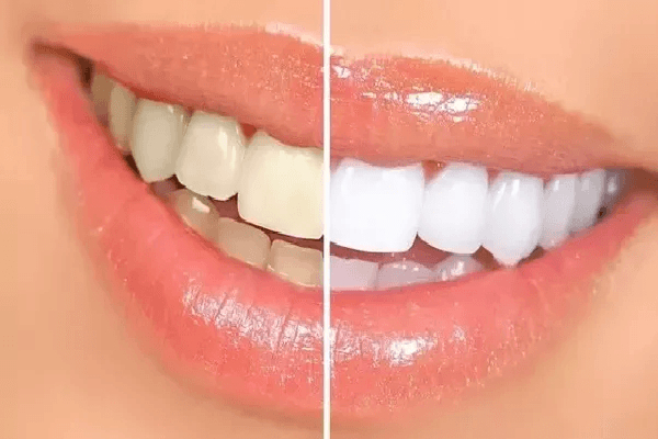 Teeth Cleaning and Whitening